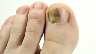 What is the treatment for hematoma under the nails?